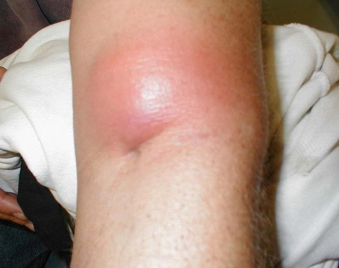 Лечение гнойно-септических заболеваний кожи