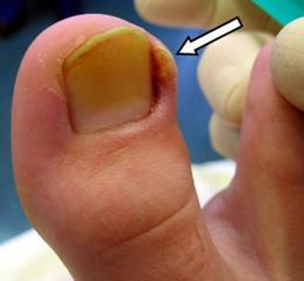Вросший ноготь (онихокриптоз) - патология ногтевой пластины 