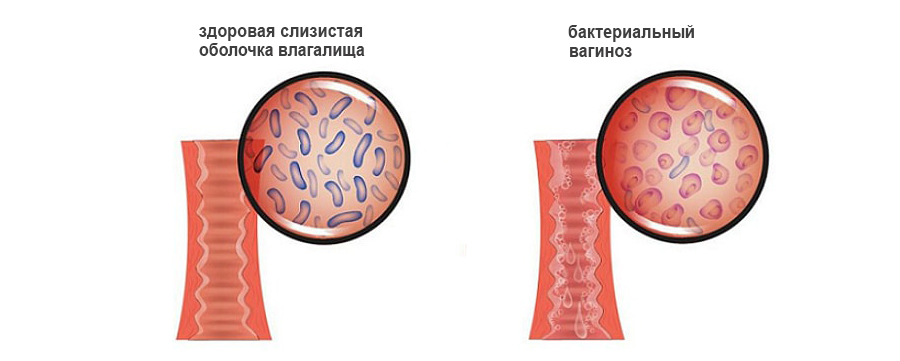 Бактериальный вагиноз — симптомы, лечение
