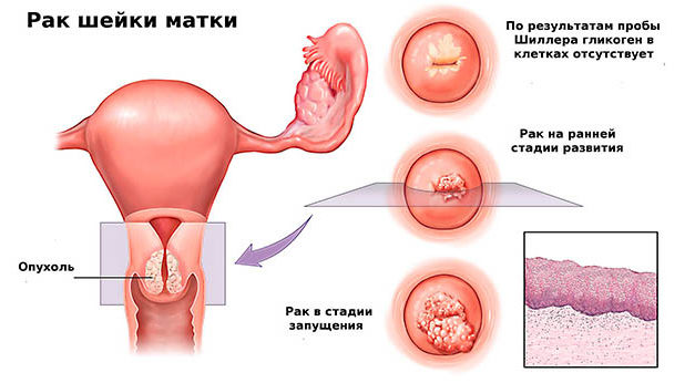 Рак шейки матки